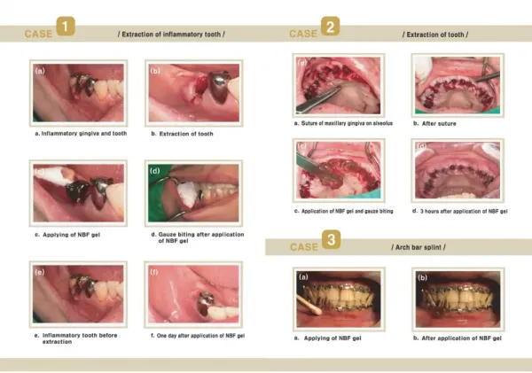 NBF GINGIVAL GÉL 2X30 g - na rany, popáleniny, herpes, zuby... 2 kusy