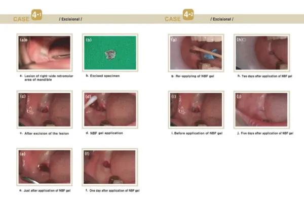 NBF GINGIVAL GÉL 2X30 g - na rany, popáleniny, herpes, zuby... 2 kusy