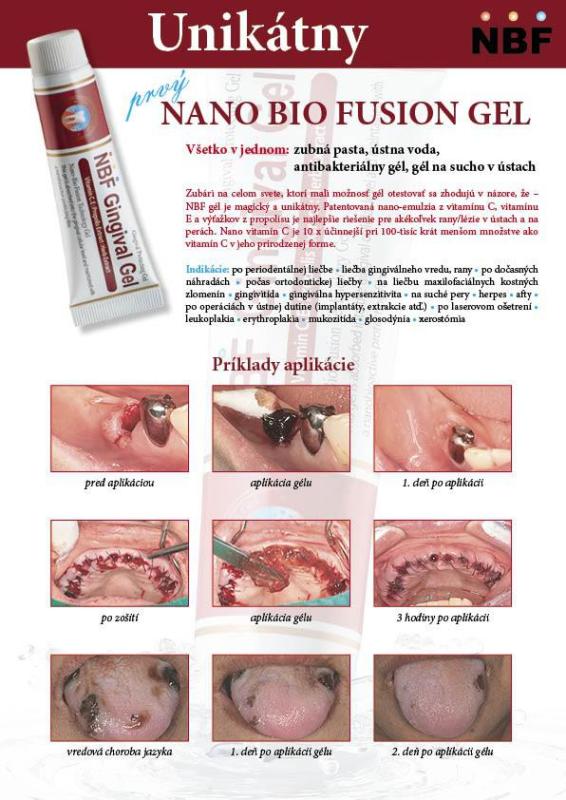 NBF GINGIVAL GÉL 2X30 g - na rany, popáleniny, herpes, zuby... 2 kusy