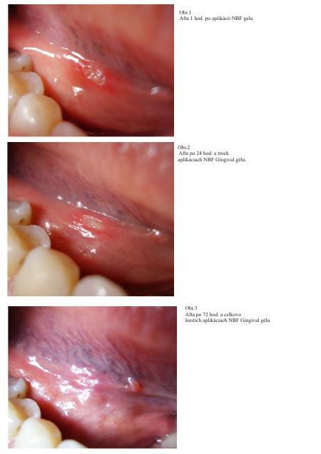 NBF GINGIVAL GÉL 2X30 g - na rany, popáleniny, herpes, zuby... 2 kusy